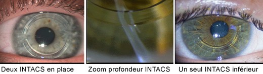 Des anneaux intracornéens