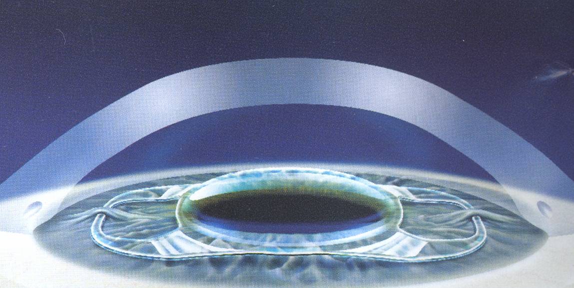 schma d'une lentille intracornenne implante